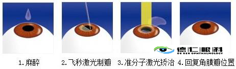  挽救视力的SMILE全飞秒激光手术，你到底能不能做?非常全面的医学科普文章