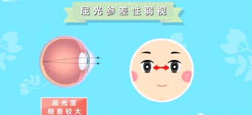 什么是弱视？弱视有哪些症状，日常生活中要如何预防？