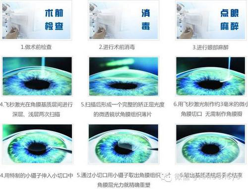 眼睛近视了，做SMILE全飞秒激光手术好不好?知道文章提到的这几点会让你更放心