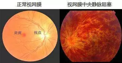  眼底病有哪些类型？日常生活当中我们应该怎样预防?