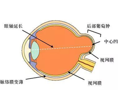  眼底病有哪些类型？日常生活当中我们应该怎样预防?