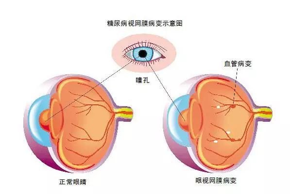  眼底病有哪些类型？日常生活当中我们应该怎样预防?