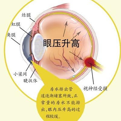 青光眼早期症状不明显，教你如何诊断！