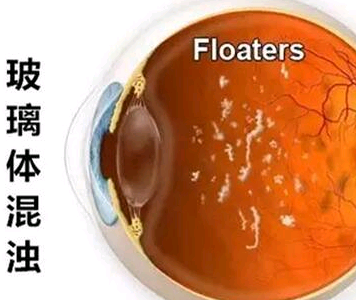 玻璃体混浊的检查项目有哪些？
